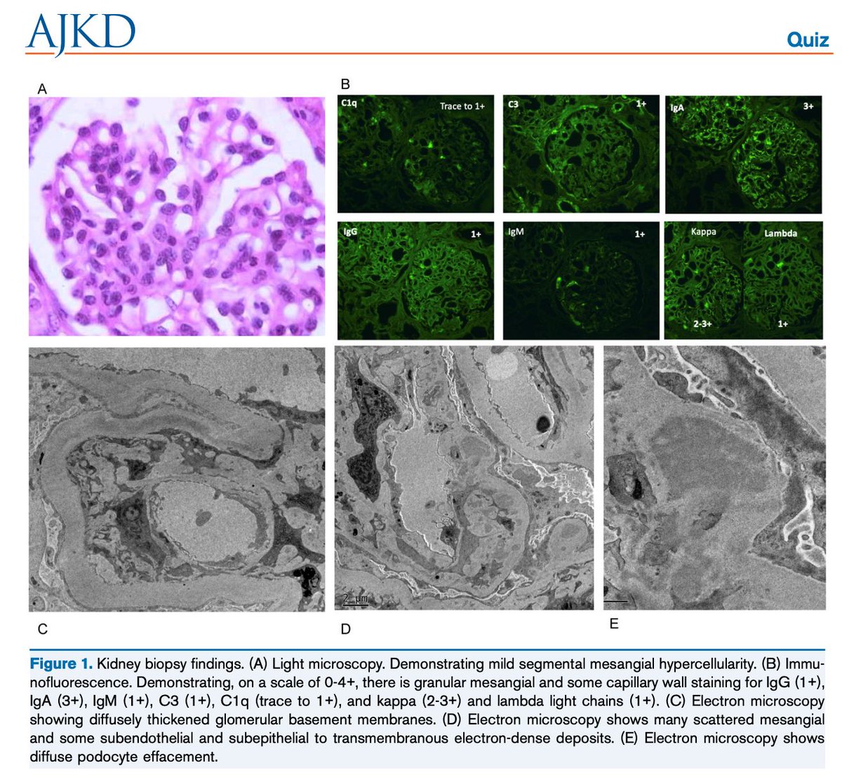 AJKDonline's tweet photo. A Patient With HIV and Nephrotic Range Proteinuria: A Quiz 

What are the differences between HIV-associated immune complex kidney disease (HIVICK) and HIV-associated nephropathy (HIVAN)? 

https://t.co/h7sCcRwSAb (FREE)

@SaynaNorouzi @zainabo87 @uofcneph https://t.co/b6kFQnPNNo
