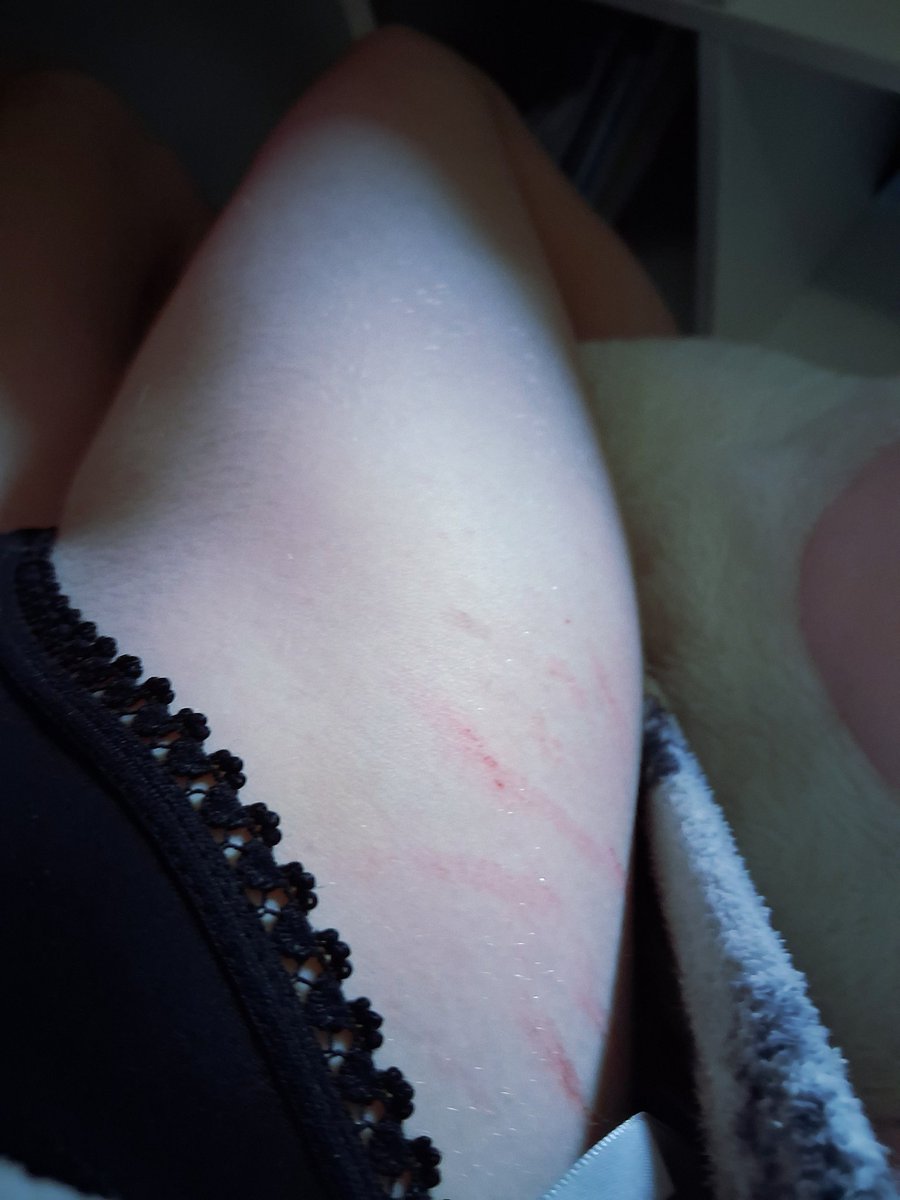 shinkleberries's tweet photo. Fresh cuts #shtwt #SELFHARMTRIGGERWARNING #selfharm https://t.co/WNgmYNx0bn