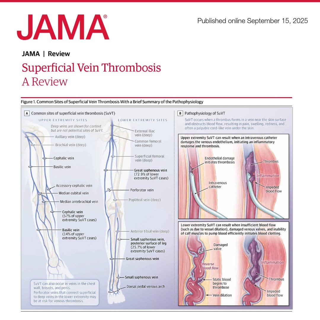 Superficial vein thrombosis (SuVT) is characterized by thrombus in the superficial veins, typically in the lower or upper extremities.

This Review summarizes the diagnosis and treatment of SuVT. 🧵 

ja.ma/42rZdhl
