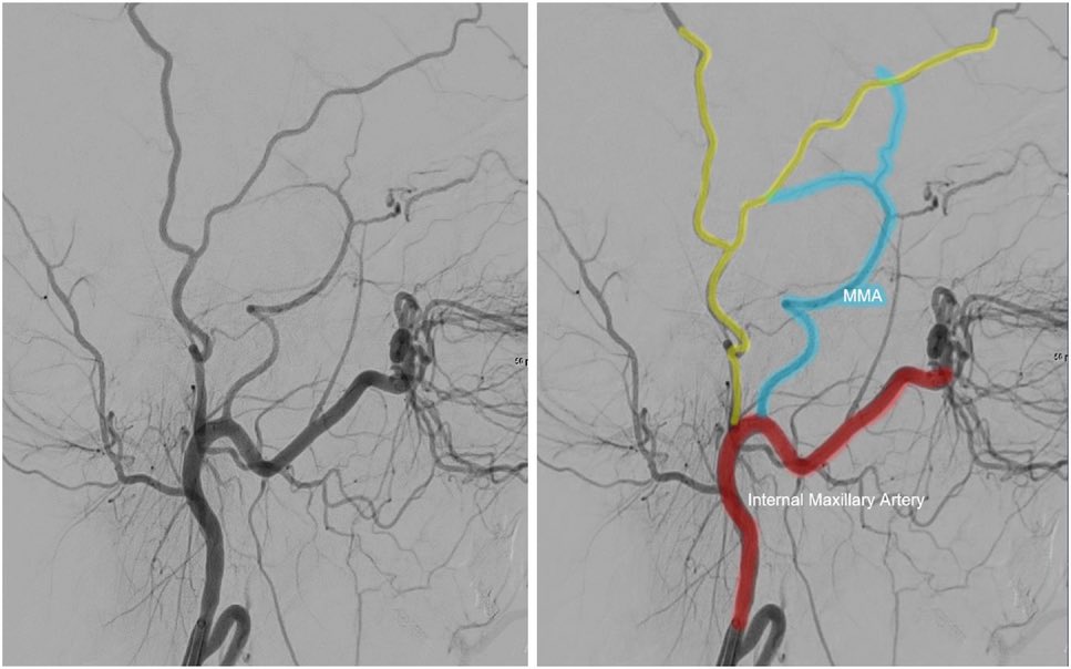 AshuJadhav (@ashupjadhav) on Twitter photo Consensus Statement on Middle Meningeal Artery Embolization in Chronic Subdural Hematoma Treatment ahajournals.org/doi/10.1161/SV… <a href="/StrokeAHA_ASA/">Stroke AHA/ASA</a> <a href="/SVINJournal/">Stroke: Vascular and Interventional Neurology</a> <a href="/StrokeAHA_ASA/">Stroke AHA/ASA</a> Consensus Statement on Middle Meningeal Artery Embolization in Chronic Subdural Hematoma Treatment ahajournals.org/doi/10.1161/SV… <a href="/StrokeAHA_ASA/">Stroke AHA/ASA</a> <a href="/SVINJournal/">Stroke: Vascular and Interventional Neurology</a> <a href="/StrokeAHA_ASA/">Stroke AHA/ASA</a>