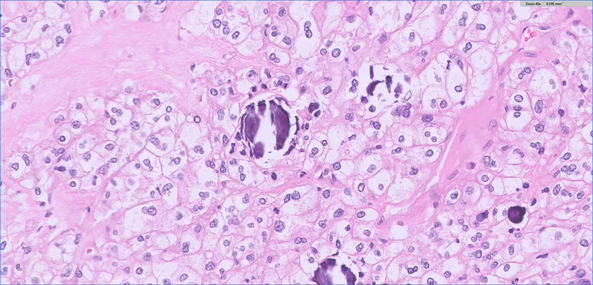 Middle-aged M, 6cm renal mass

#GUpath nephrectomy performed

DDx?