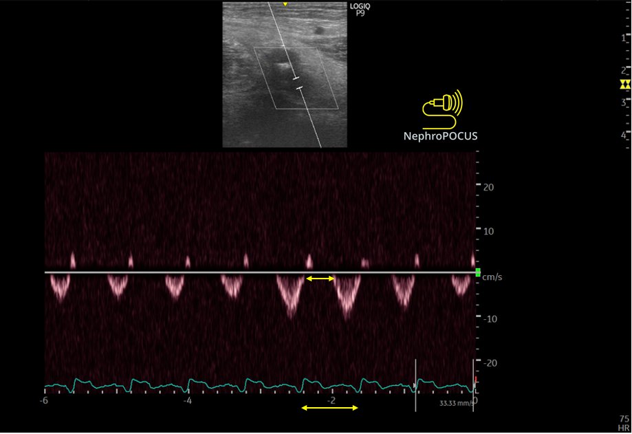 "Hi nephrology, we are holding diuretics because the creatinine is rising!"
Meanwhile the femoral vein 👇 Note the stasis index.
#POCUS #VExUS #Nephpearls