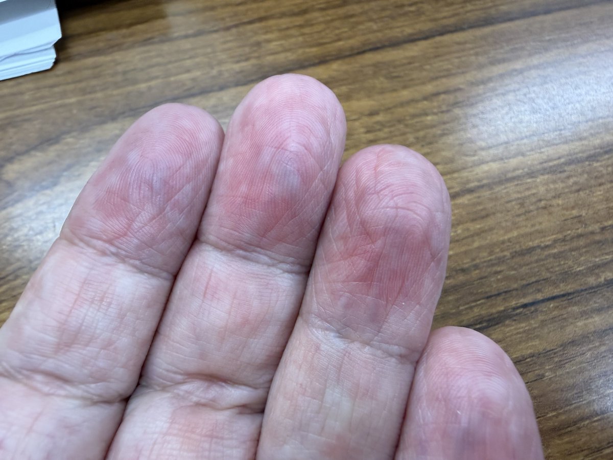 fuk89314's tweet photo. シワシワになってきた
爪の赤みも徐々に
EGFR(Pmab)だね
ひどく進まないように🥺
お手入れお手入れ大事だね
#EGFR
#Pmab https://t.co/bYWdJacJTC