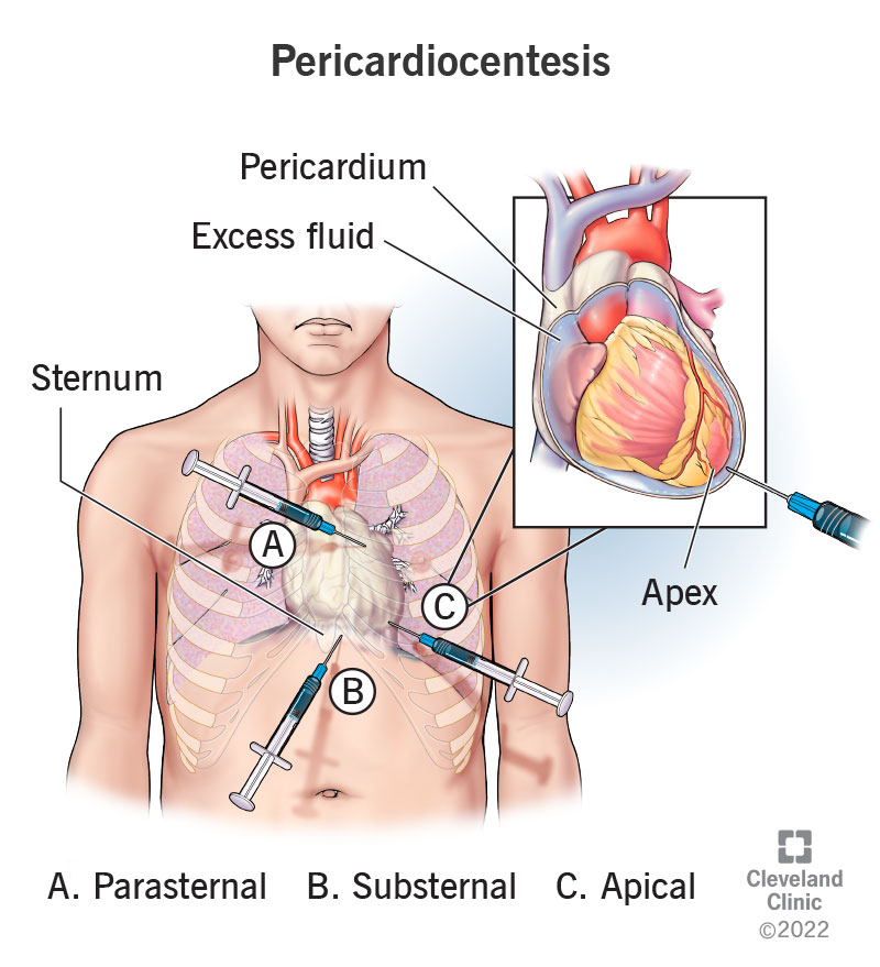 TrackYourHeart's tweet photo. Which sign indicates successful pericardiocentesis in tamponade?
A) Increased JVP
B) Fall in systolic BP
C) Disappearance of pulsus paradoxus
D) Development of pericardial rub https://t.co/EE3Gc9l8PP