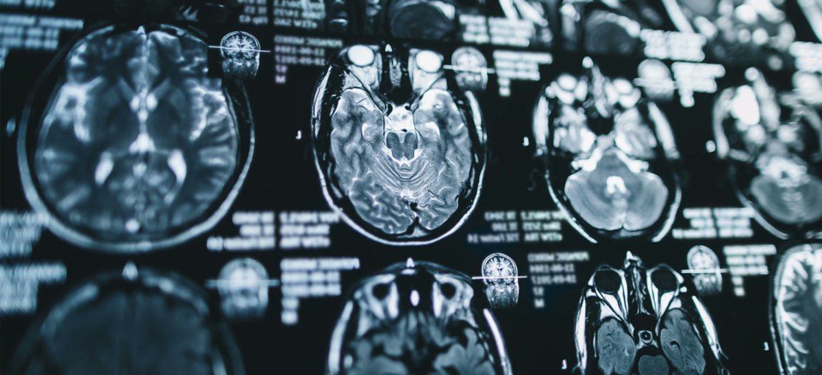 Utilidad de los biomarcadores para la #EsclerosisMúltiple Latente

Un artículo sobre el papel de la cadena ligera de los neurofilamentos (NfL), la proteína acida fibrilar glial (GFAP) y la chitinasa 3-like 1 (CHI3L1).

Un contenido de Campus Sanofi exclusivo para profesionales