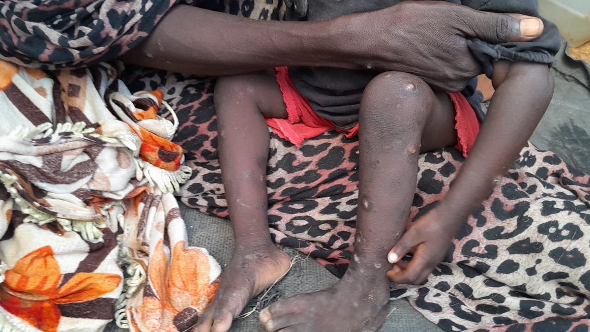 ⭕️The death rate has risen to three deaths daily during the past week in #AbuShouk camp

SAID JBREAL ONE OF THE VOLUNTEERS IN THE CAMP

As you know, the autumn season is still ongoing in Sudan,
and the rainfall is heavy in West and South #Sudan