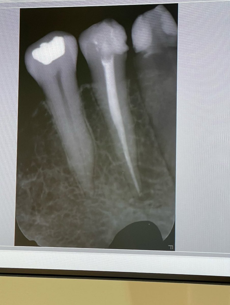 Root canal treatment for #44
first case✨