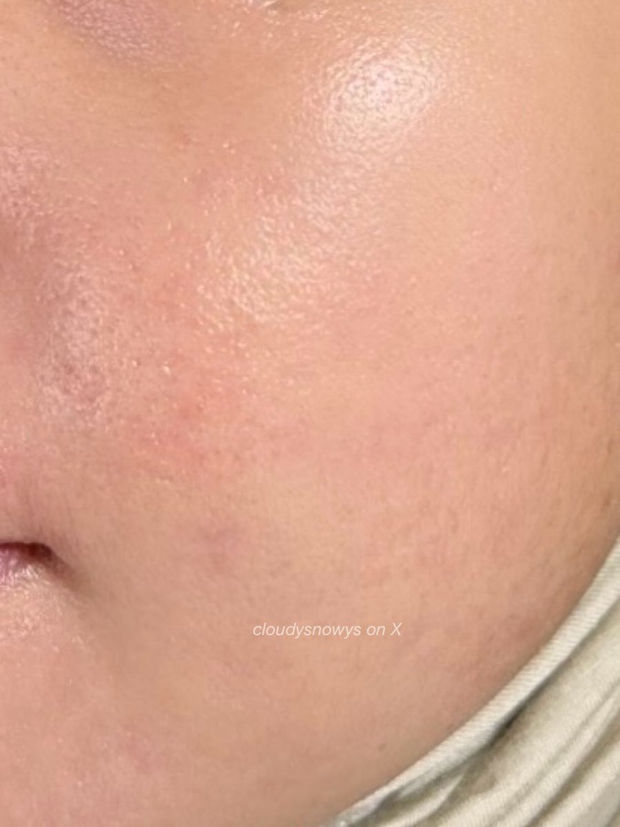 kalau muncul redness atau kulit kering udah paling oke buat kencengin basic pakai moisturizer

semingguan redness udah calming banget 🥹

From this:                               To this: