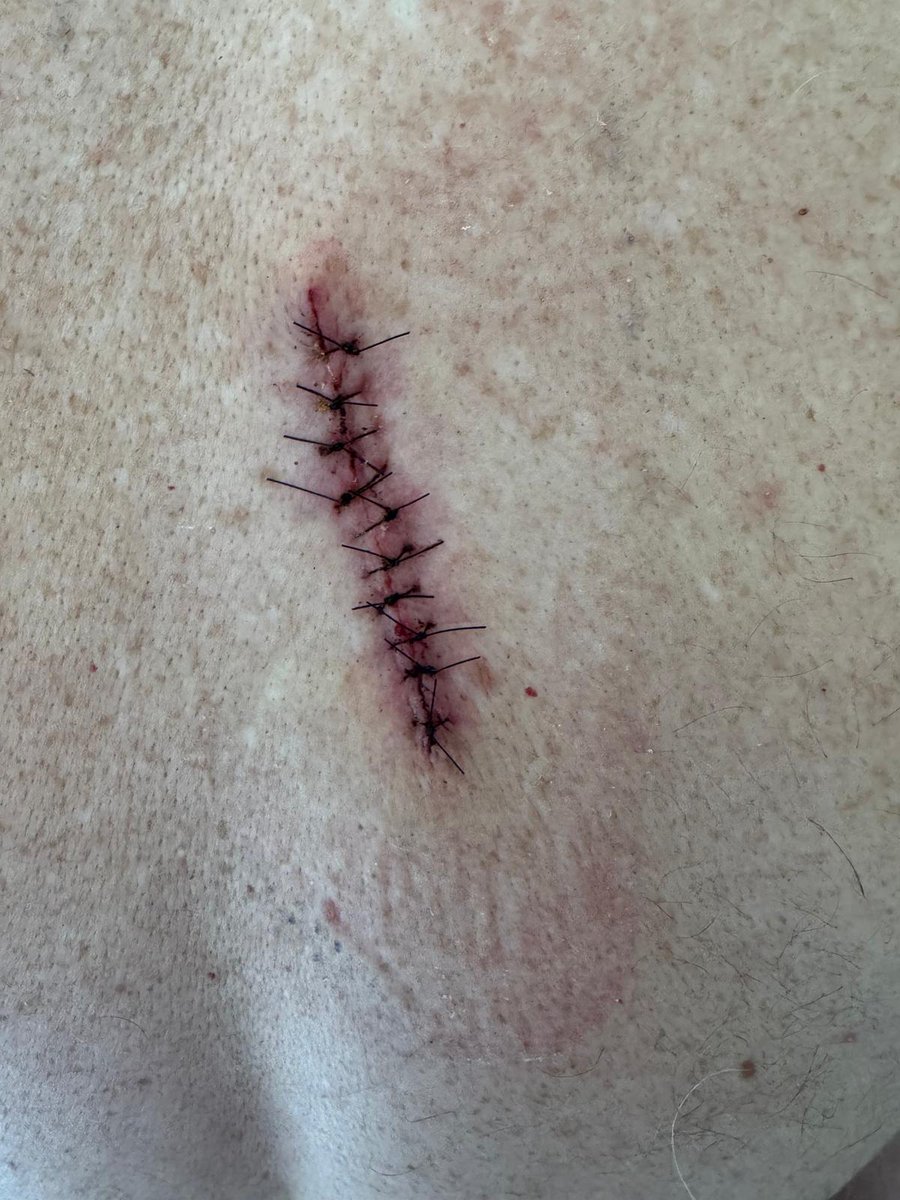 Wouldn't normally post this, but think important to regularly check your back my friends - especially if you live alone. Beth flagged up a sus looking mole, which Broomfield hospital have done a lovely job of removing. Awaiting biopsy now, but I'd probably never have noticed it.