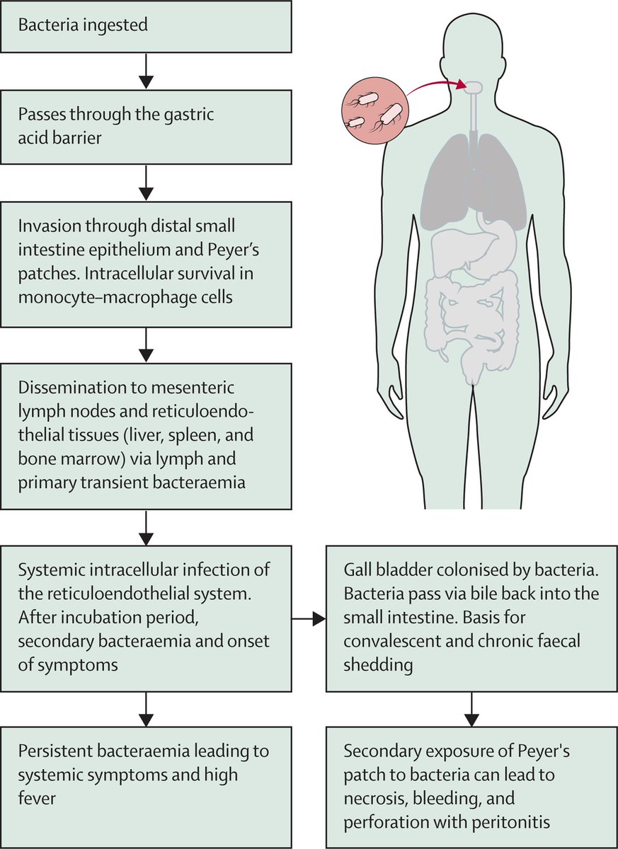Case management of enteric fever is challenging due to clinical presentation overlaps, unreliable diagnostic tests, &amp; widespread AMR.

A new Seminar explores the evidence supporting effective case management of patients with suspected enteric fever: hubs.li/Q03GRPdF0