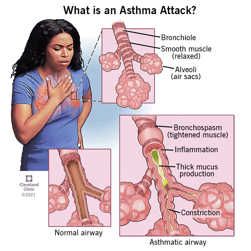 Fahadalghamdiie's tweet photo. مرض الربو Asthma - ربط الادوية والتفاصيل ⬇️
https://t.co/f1G3RQzz1b
#respiratory_system https://t.co/Kenhh4Tr8o