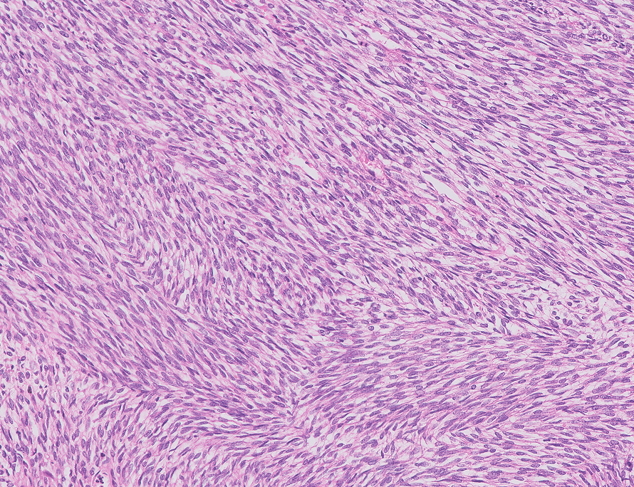 FelipePatologia's tweet photo. A classic monophasic spindle cell Synovial Sarcoma and its next generation immunohistochemical marker, the antibody SSX::SS18, which identifies the fusion protein of this fusion driven sarcoma.

Baranov E, et al. PMID: 32141887 https://t.co/yjKfZLjT8k