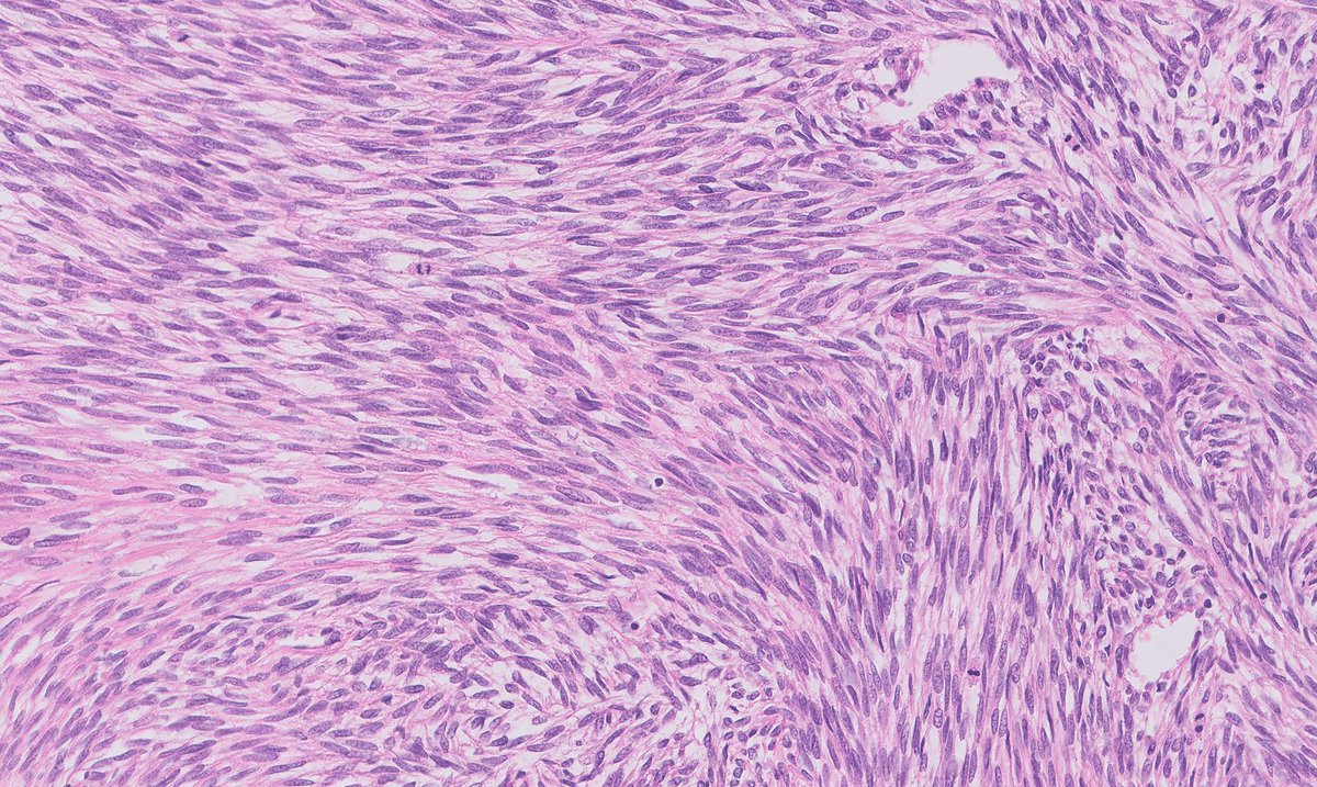 FelipePatologia's tweet photo. A classic monophasic spindle cell Synovial Sarcoma and its next generation immunohistochemical marker, the antibody SSX::SS18, which identifies the fusion protein of this fusion driven sarcoma.

Baranov E, et al. PMID: 32141887 https://t.co/yjKfZLjT8k