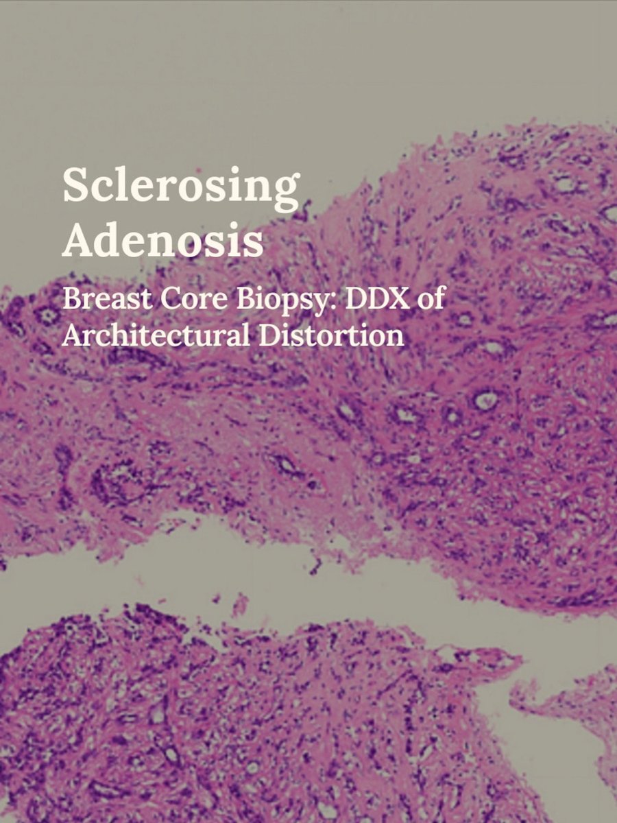 Sclerosing adenosis can present as architectural distortion on imaging, and is a great mimicker of carcinoma.

thepathprincess.substack.com/p/sclerosing-a…

It's all about finding those two cell layers.🔬 #pathology #pathologist #breastpath #pathX #PathTwitter