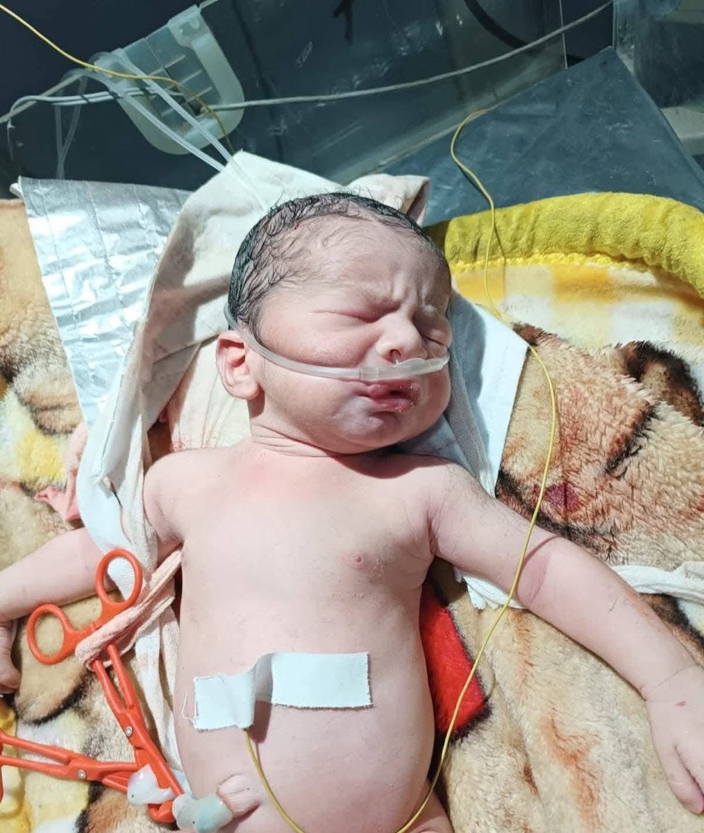 🚨BREAKING: In Gaza, a baby was delivered by emergency C-section after Israel bombed his family’s tent. His mother was killed instantly, his father moments later. 

He begins life alone without parents, only a birth certificate marked by massacre.

- Dr. Munir Al-Bursh, Director