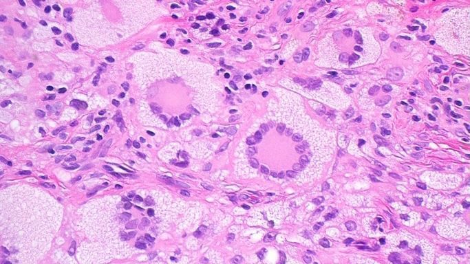 JMGardnerMD's tweet photo. Yellow-red papule. Forehead of 5yo boy. One pic only.  
Answer ✅ https://t.co/25LqN9rYKl 
#pathology #pathologists #pathTwitter #dermpath #dermatology #dermatologia #dermtwitter https://t.co/SX1vd9wLIb