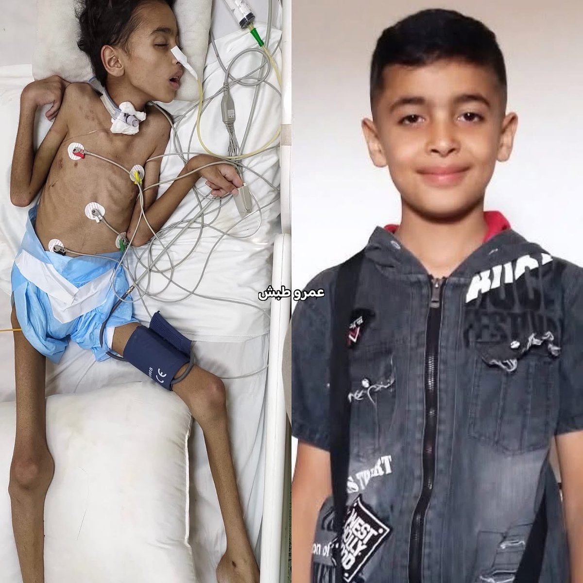 ุญุณุงู
ุดุจุงุช (@hossamshabat) on Twitter photo ุงูุทูู ุฅููุงุจ ูุดุงุญ (11 ุนุงู
ูุง)ุ ุงููุญูุฏ ููุงูุฏููุ ุฃุตูุจ ุจุดุธุงูุง ูู ุงูููุจ ูุงูุฑุฆุฉ ุฌุฑุงุก ุตูุงุฑูุฎ ุงูุงุญุชูุงูุ ู
ุง ุชุณุจุจ ุจุชููู ููุจู ุฃูุซุฑ ู
ู ุฃุฑุจุน ู
ุฑุงุชุ ูุฃุฏู ุฅูู ุถู
ูุฑ ูู ุงูุฏู
ุงุบ ูุชุฌ ุนูู ุดูู ูุงู
ู ูุชุดูุฌุงุช ุฎุทูุฑุฉ ู
ุชูุงุตูุฉุ ุฅุถุงูุฉ ุฅูู ุงุฑุชูุงุน ู
ุณุชู
ุฑ ูู ุงูุญุฑุงุฑุฉ ูุณูุก ุชุบุฐูุฉ ุญุงุฏ ุจุณุจุจ ููุต ุงูุนูุงุฌ ูุงูุทุนุงู
ูุชูุฌุฉ ุงูุทูู ุฅููุงุจ ูุดุงุญ (11 ุนุงู
ูุง)ุ ุงููุญูุฏ ููุงูุฏููุ ุฃุตูุจ ุจุดุธุงูุง ูู ุงูููุจ ูุงูุฑุฆุฉ ุฌุฑุงุก ุตูุงุฑูุฎ ุงูุงุญุชูุงูุ ู
ุง ุชุณุจุจ ุจุชููู ููุจู ุฃูุซุฑ ู
ู ุฃุฑุจุน ู
ุฑุงุชุ ูุฃุฏู ุฅูู ุถู
ูุฑ ูู ุงูุฏู
ุงุบ ูุชุฌ ุนูู ุดูู ูุงู
ู ูุชุดูุฌุงุช ุฎุทูุฑุฉ ู
ุชูุงุตูุฉุ ุฅุถุงูุฉ ุฅูู ุงุฑุชูุงุน ู
ุณุชู
ุฑ ูู ุงูุญุฑุงุฑุฉ ูุณูุก ุชุบุฐูุฉ ุญุงุฏ ุจุณุจุจ ููุต ุงูุนูุงุฌ ูุงูุทุนุงู
ูุชูุฌุฉ