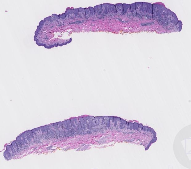 "Are all "halo" lesions halo nevi?" kikoxp.com/posts/62415/pu…