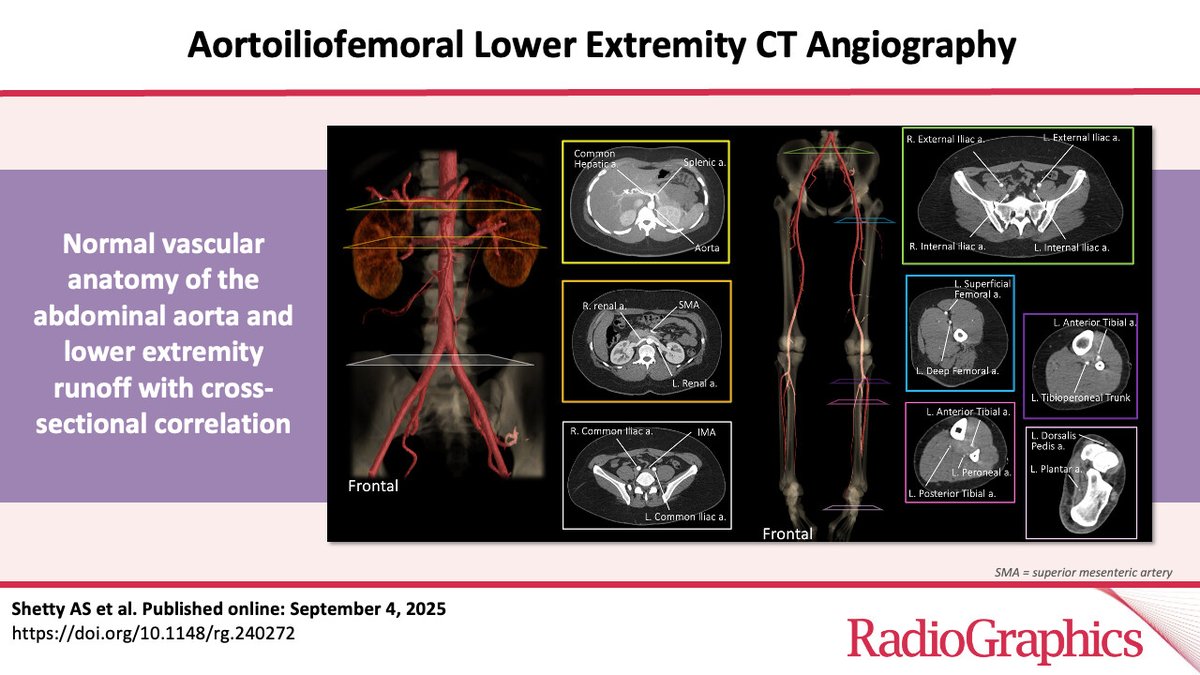 nupedogg's tweet image. AIF lower extremity CTA can be a challenging, time-consuming radiology study to interpret. Our @RadioGraphics work offers practical guidance on anatomy, CTA technique, radiologic interpretation, and pitfalls.

pubs.rsna.org/doi/10.1148/rg…

@WashUMedMIR #AIF