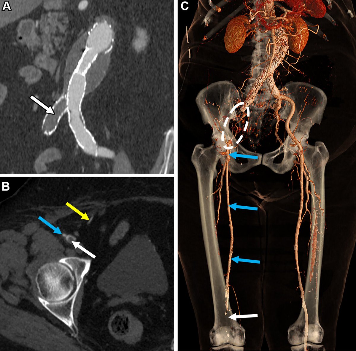 nupedogg's tweet image. AIF lower extremity CTA can be a challenging, time-consuming radiology study to interpret. Our @RadioGraphics work offers practical guidance on anatomy, CTA technique, radiologic interpretation, and pitfalls.

pubs.rsna.org/doi/10.1148/rg…

@WashUMedMIR #AIF