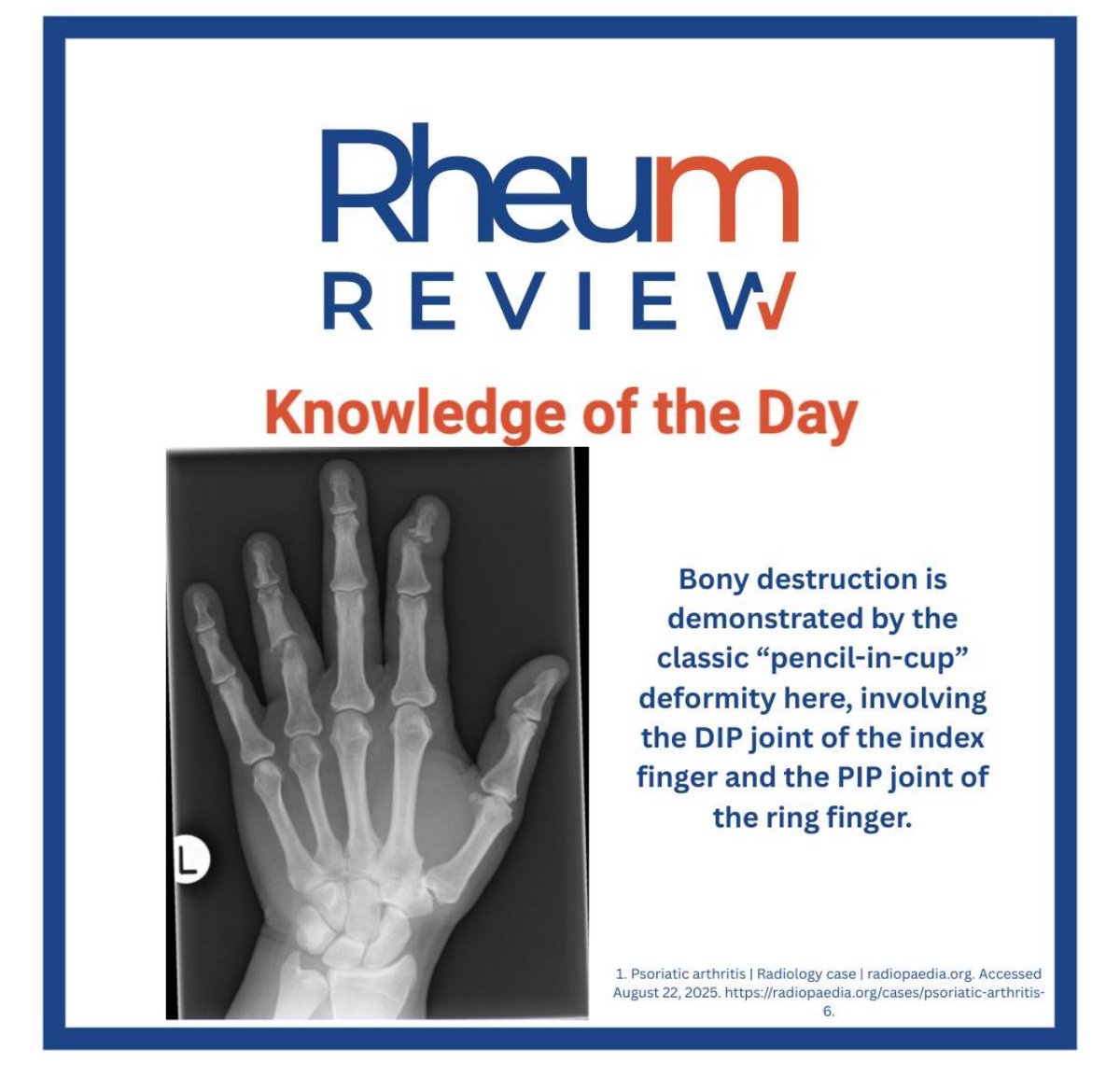 ⚠️’Pencil in cup’ deformity - 
highly suggestive of #PsoriaticArthritis

There are proliferative and erosive bone changes concurrently  

#erosivedisease #PsA #IA #Biolgics #DMARDS #psoriasis 

By <a href="/therheumreview/">Rheum Review</a>