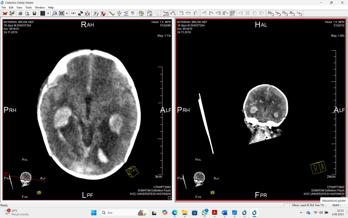 1) T.C. Yenibosna Adli Tıp Kurumu
Bu kurum ve yaptığı otopsi ile yazacağım çok detay var ama herkes tarafından anlaşılır yazmam gerektiği için burada sadece beyin kanaması konusuna değineceğim. Adli Tıp kurumu tarafından yapılan otopside beyinde kanam olduğu beyinin ileri derece