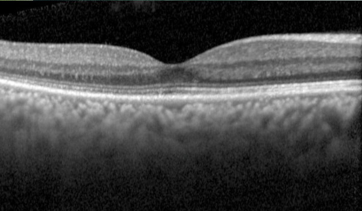 Central serous retinopathy. Note classic smokestack leakage temporally on fluorescein angiography. OCT demonstrates subretinal fluid (20/300) that resolved without treatment (20/40) in 2 months.