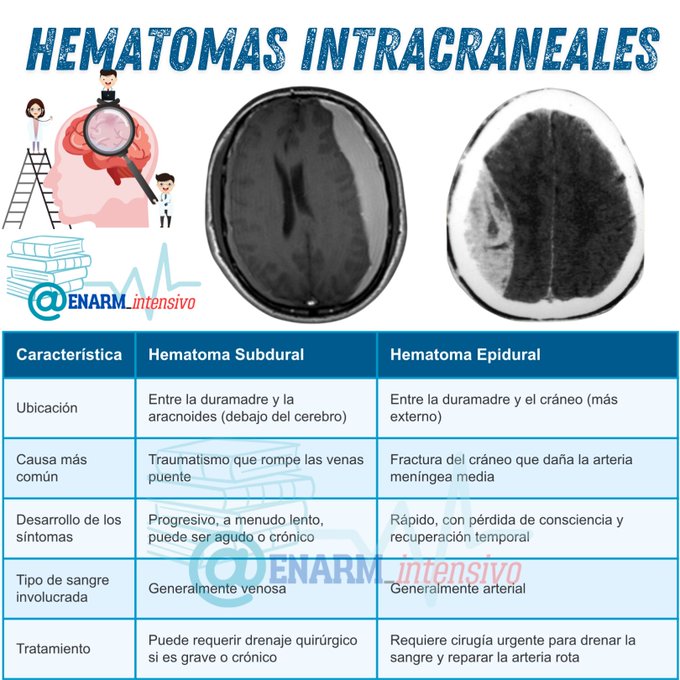 💢HEMATOMAS  INTRACRANEALES

#ENARM_INTENSIVO #ESTUDIA_MEDICINA