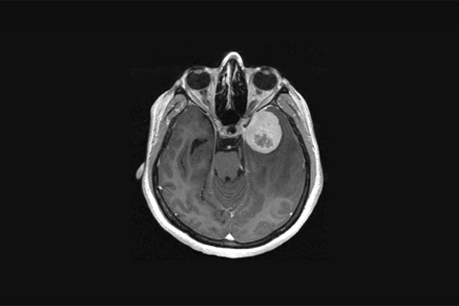 UHN's tweet photo. A new study published in The Lancet Oncology, from a research team at UHN's Princess Margaret Cancer Centre found that grading of meningiomas may be improved by evaluating the expression of the telomerase reverse transcriptase (TERT) gene.

Read more: https://t.co/1oehS2GC7t https://t.co/9buzoCh2Hg