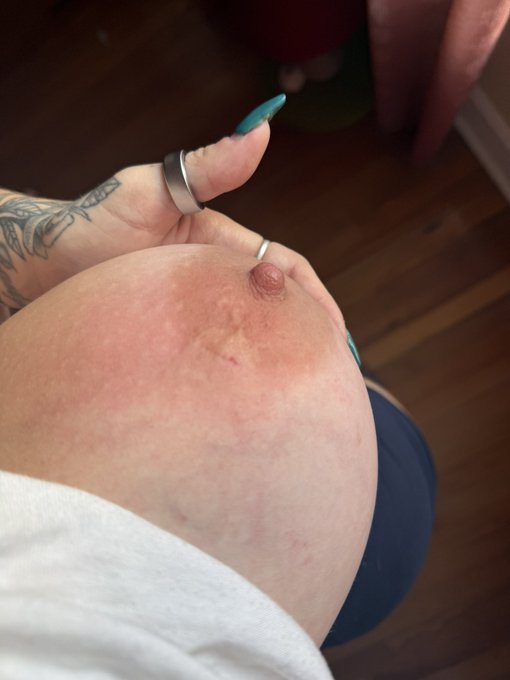 2 pic. even the wasps love my titties 🤕 https://t.co/nsY03TtjuW