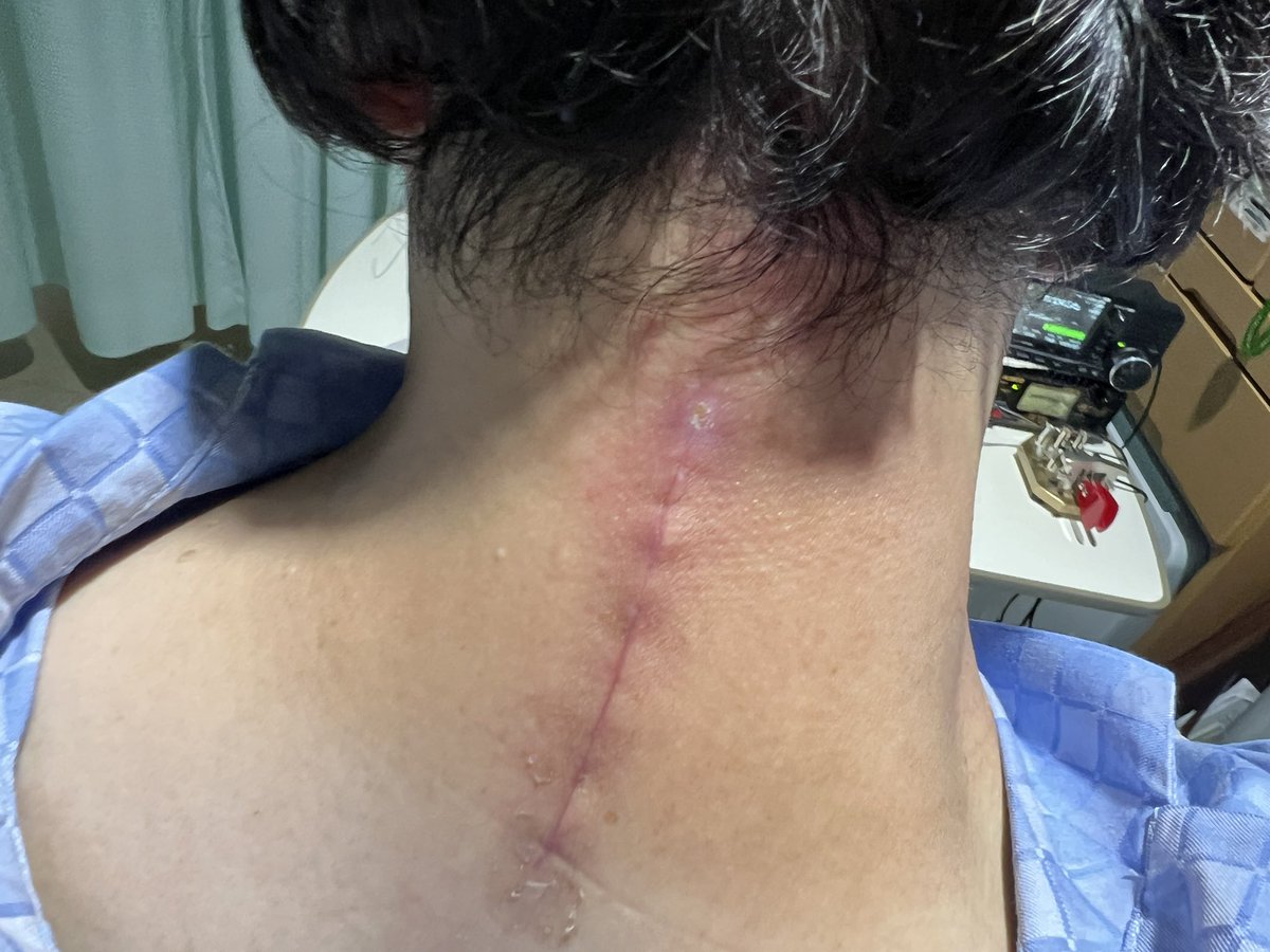 術後21日目。今日で手術3週間。傷口も良くなって歩行器と，杖の両方で歩行。首の傷の痛みは感じないけれど首周りの筋が痛く首を動かす痛い。右手首、左手首、両足首の痺れはあるもののあまり気にならず、右手に力が入らず握れないのが気になる。写真はリアルで閲覧注意
＃頚椎症性脊髄症
＃椎弓形成術