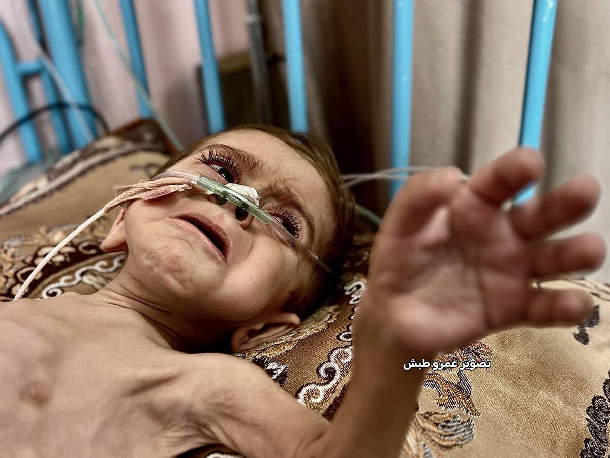 QudsNen's tweet photo. Three-year-old Karim Muammar is facing the risk of death in Gaza due to severe malnutrition, liver enlargement, and rickets, as Israel prevents him from traveling abroad for medical treatment and deprives him of food and medicine under the ongoing blockade and war. https://t.co/MyS1Xi155L