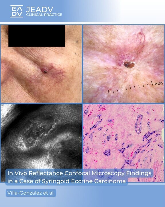 Villa-Gonzalez et al. report a #syringoid eccrine #carcinoma in a 77yo woman. 
Reflectance confocal microscopy showed hyporeflective luminal structures in sclerotic stroma, confirmed by #biopsy and Mohs surgery. 

Full article 👉 bit.ly/3HwizL2