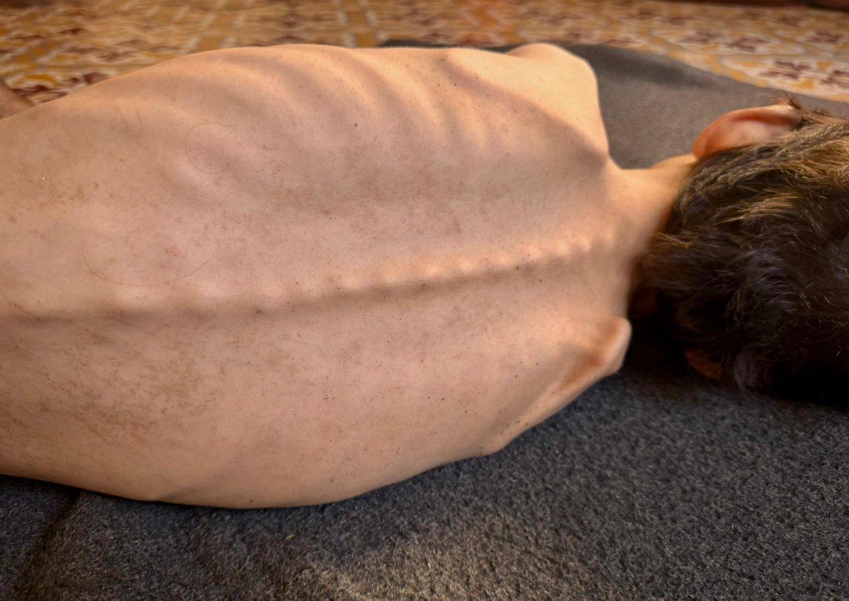 🔴 Desde enero, en Gaza, se han reportado alrededor de 44.000 ingresos de niños y niñas para el tratamiento de la desnutrición aguda.
La hambruna se agrava y si no entran suministros inmediatamente, el número de muertes por inanición seguirá aumentando.