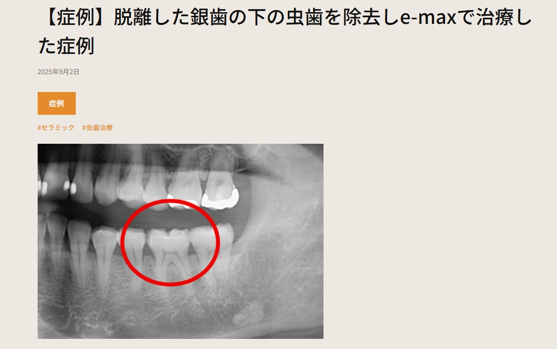 setagaya_DC's tweet photo. 症例をUPしました！！  【症例】脱離した銀歯の下の虫歯を除去しe-maxで治療した症例 https://t.co/lJEshP1SYD

＃せたがや歯科室　＃松陰神社前　＃症例　＃セラミック　＃24時間web予約受付中　＃バリアフリー　＃駅チカ　＃駐輪場あり　＃女医常駐 https://t.co/IX18XEWd79