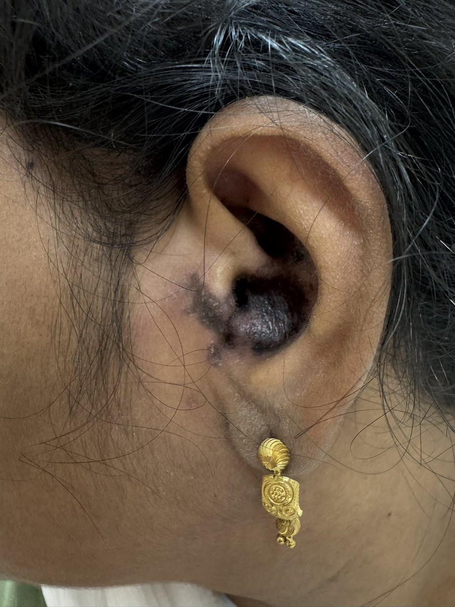 DrSamB21's tweet image. Never miss to look in the ear!
Shuster sign #DLE rash , could be harbinger of Lupus #SLE
#MedTwitter #rheumtwitter
@thisis_drgsp @Janetbirdope