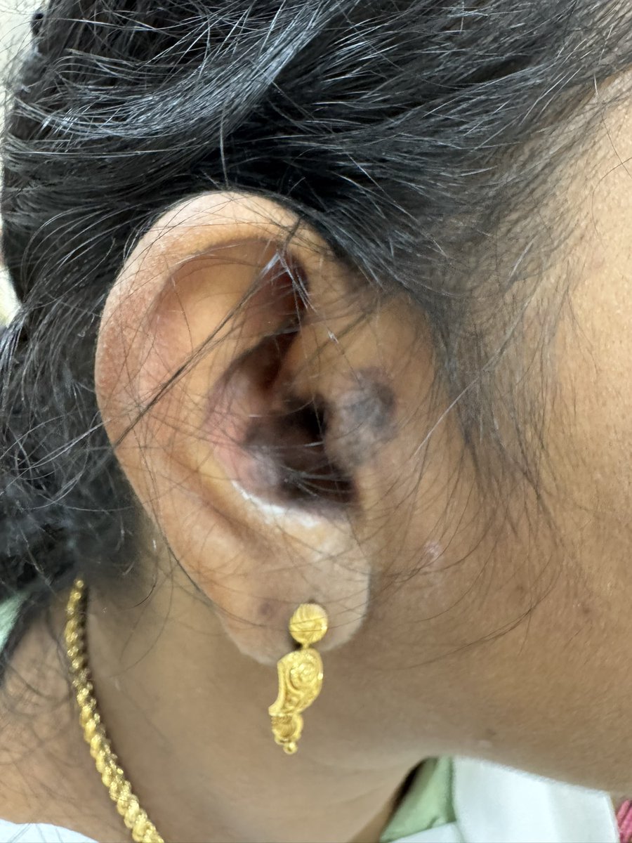 DrSamB21's tweet image. Never miss to look in the ear!
Shuster sign #DLE rash , could be harbinger of Lupus #SLE
#MedTwitter #rheumtwitter
@thisis_drgsp @Janetbirdope