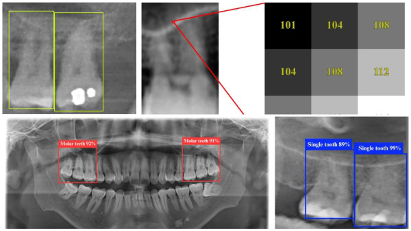 otexeworld's tweet photo. 🤖 AI Boosts Dental X-Ray Accuracy
A new AI tool detects teeth and sinus structures on x-rays with 98.2% accuracy. It spots signs of odontogenic sinusitis in real time, reduces CT scan use, speeds up diagnosis, and helps clinics with limited resources provide faster, safer care. https://t.co/iUDi0BvSr0