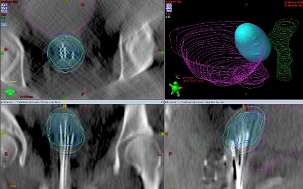 MVCCbrachy's tweet image. ✨At MVCC, we’re proud of our radiotherapy expertise in:
 ⚡Advanced Radiotherapy – Using techniques including adaptive IMRT/VMAT 
 🎯Brachytherapy– internal radiotherapy for high dose, precise treatments
 🎯Stereotactic Body Radiotherapy (SBRT) – targeted, high-dose treatments.