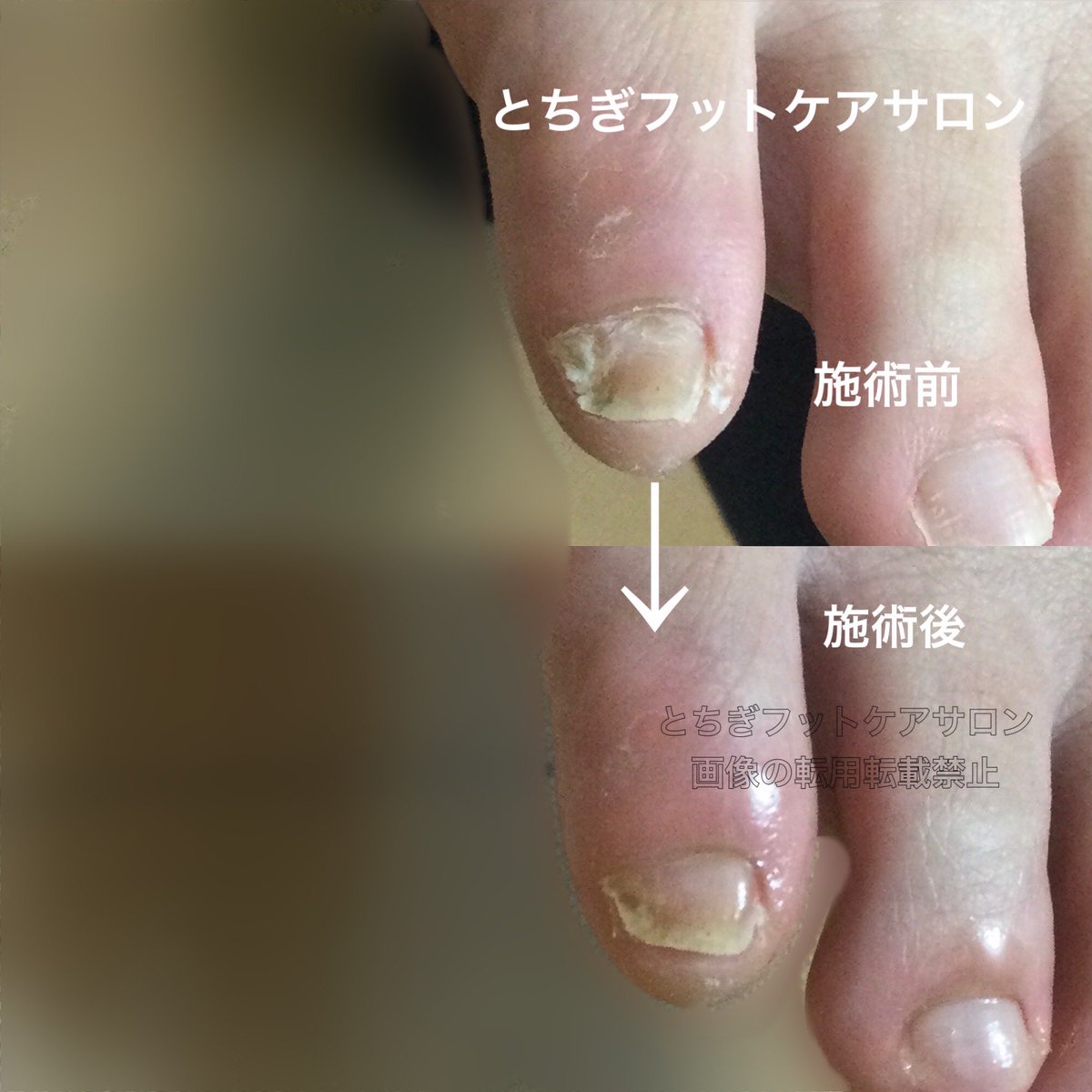 とちぎフットケアサロン-茂木有紀 (@fuss04tochigi) / Posts / X