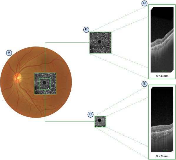 📖 En #accesoabierto no #RUC o recente artigo do <a href="/VarpaGroup/">VARPA Group</a>:
"Inter-expert reliability in multi-field-of-view automatic drusen segmentation analysis using optical coherence tomography"

🔗 hdl.handle.net/2183/45719