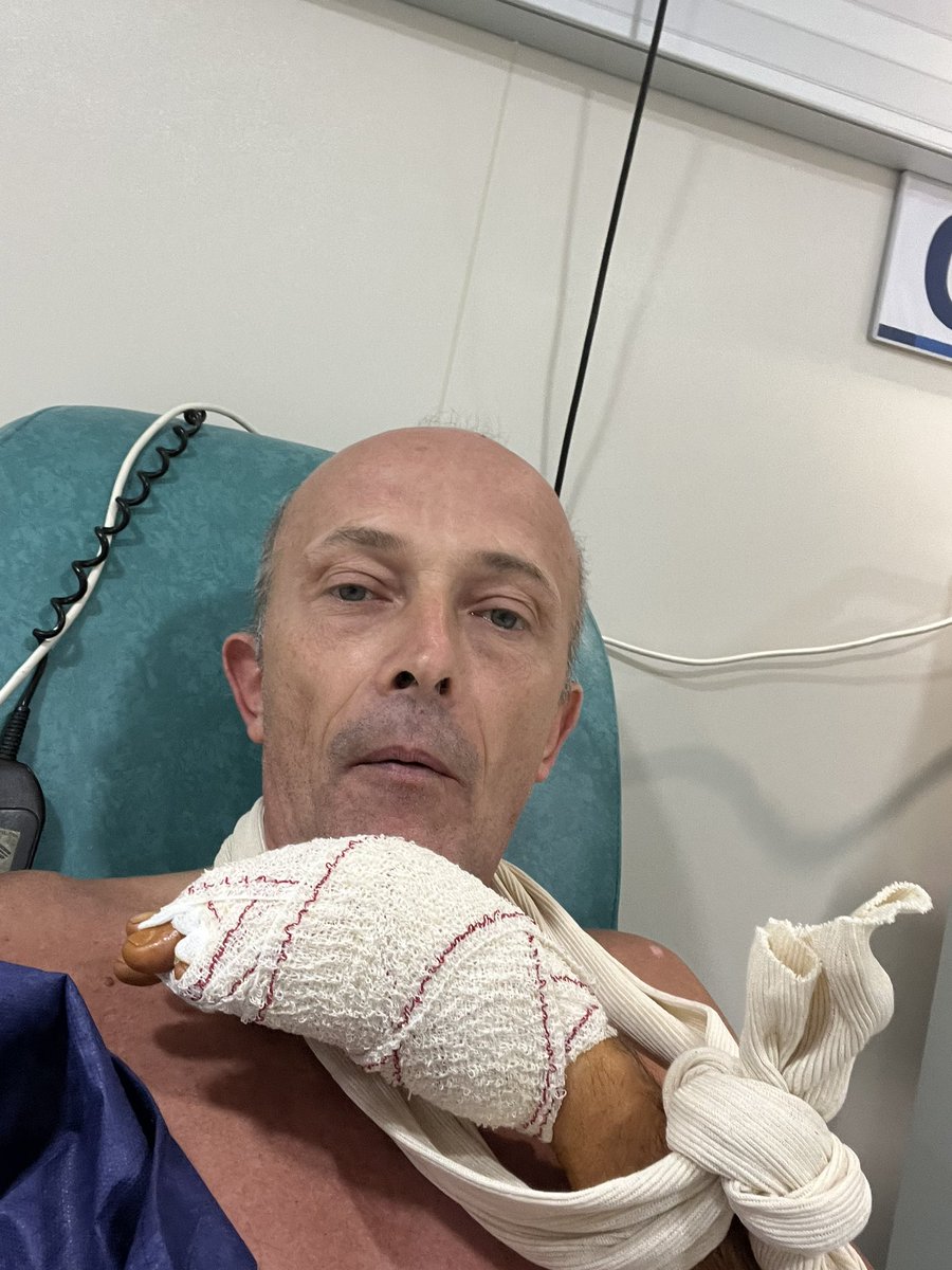 fredericroynice's tweet photo. Dupuytren 4eme opérations , maladie irréversible des mains , petit à petit mes mains se ferment et deviennent dures comme de la pierre l’opération me permet de retrouver une flexibilité pour 3 ou 4 ans pour rouler mes pains au chocolat 😜 https://t.co/72qFNHzOhO