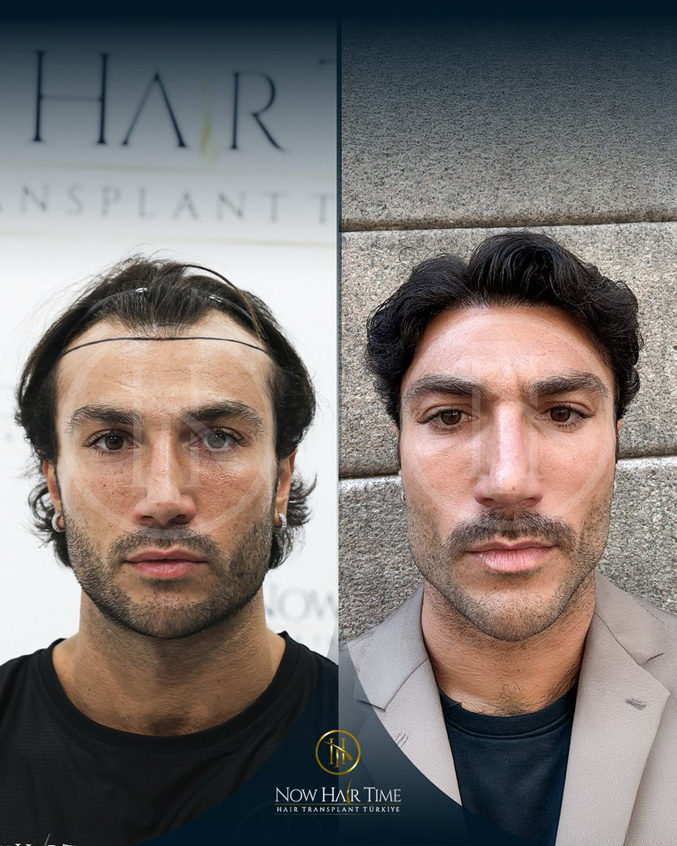 Hair Transplant Results!   #hairtransplant #hairtransplantation #hairtransformation #hairtransplantclinic #hairjourney #hairtreatments #hair #beforeafterhair #hairgoals #haircarespecialist #haircarespecialist #trapiantocapelli #trapiantodicapelli