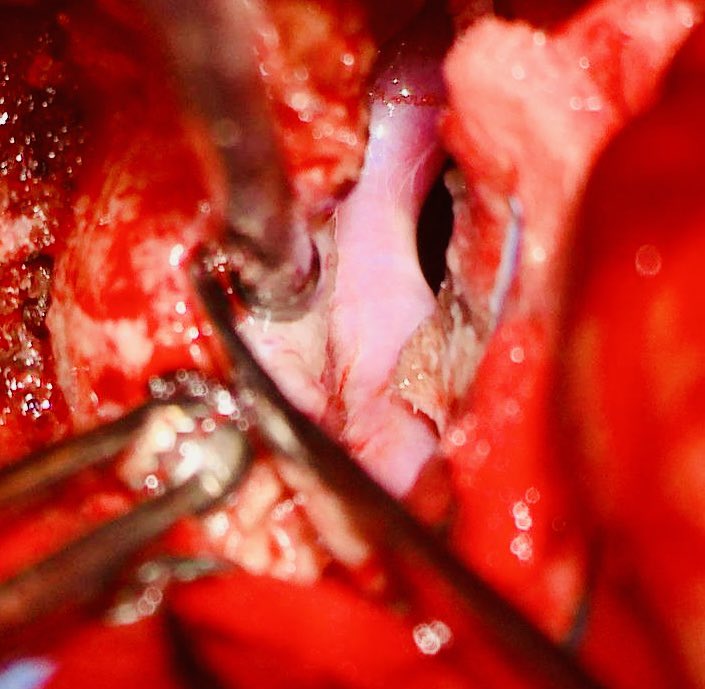 DROSCARZORRO's tweet image. La Microcirugía continúa siendo pilar fundamental en el tratamiento de los meningiomas.