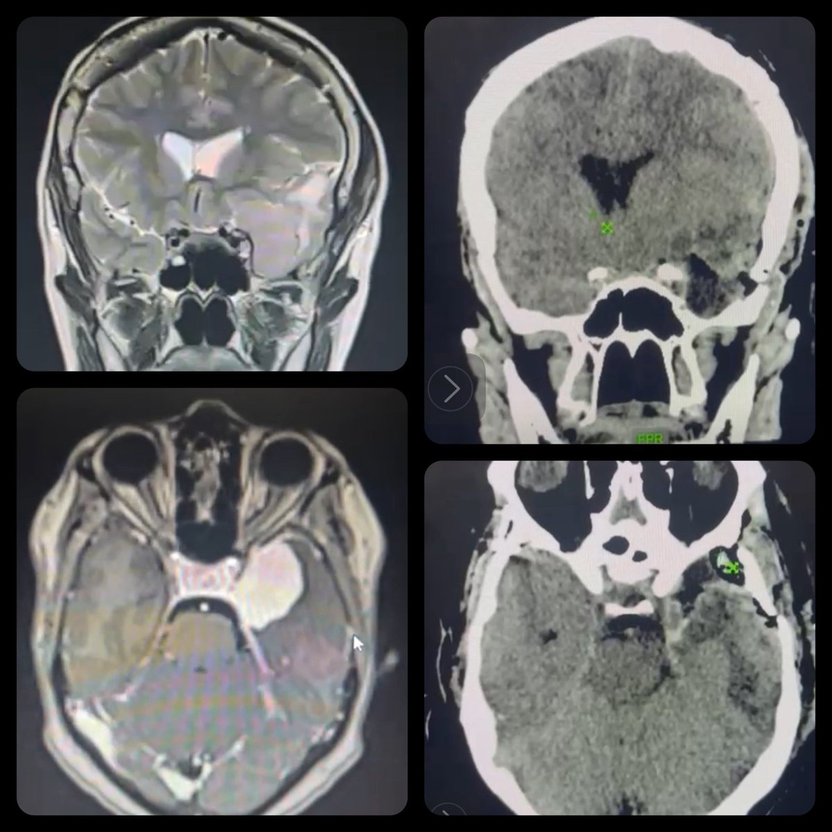 DROSCARZORRO's tweet image. La Microcirugía continúa siendo pilar fundamental en el tratamiento de los meningiomas.