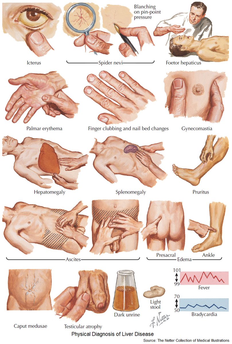 physical diagnosis of liver disease