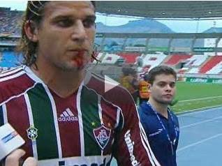 NoFilterFFC's tweet image. Lembranças… brasileirão de 2011:

-Renato Abreu agride Rafael Moura sem bola intencionalmente

-vermelho? Amarelo? Falta? Nem falta o juiz marcou

-Rafael Moura, ensanguentado, cuspiu sangue em cima do Renato

Resultado:

Renato: ABSOLVIDO
Rafael Moura: 10 JOGOS DE SUSPENSÃO