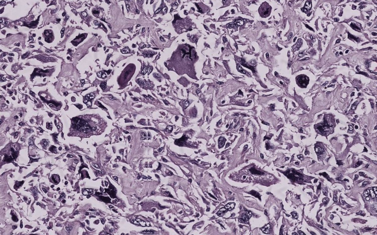 pathphyo's tweet image. A dreadful carcinosarcoma (metaplastic carcinoma) of breast featuring poorly differentiated glands and sarcomatoid (metaplastic) component. IHC showed a triple negative carcinoma. Associated with poor prognosis.
#pathology #breastpath #metaplastic_carcinoma