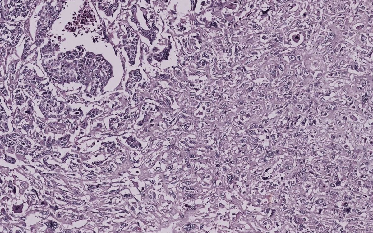 pathphyo's tweet image. A dreadful carcinosarcoma (metaplastic carcinoma) of breast featuring poorly differentiated glands and sarcomatoid (metaplastic) component. IHC showed a triple negative carcinoma. Associated with poor prognosis.
#pathology #breastpath #metaplastic_carcinoma
