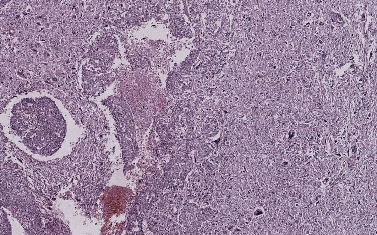 pathphyo's tweet image. A dreadful carcinosarcoma (metaplastic carcinoma) of breast featuring poorly differentiated glands and sarcomatoid (metaplastic) component. IHC showed a triple negative carcinoma. Associated with poor prognosis.
#pathology #breastpath #metaplastic_carcinoma